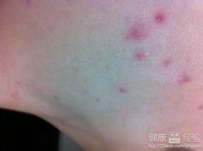 酒精过敏的图片,从图片看症状与预防