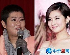 selina烧伤照片,勇敢面对伤痛，绽放生命光芒